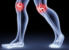 Due to the development of arthrosis of the knee