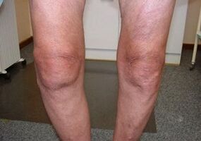 How to treat arthrosis of knee joint