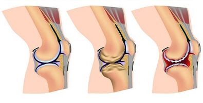 Knee joint stages of development of arthrosis