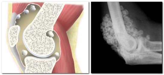 Chondromatosis with hip joint pain
