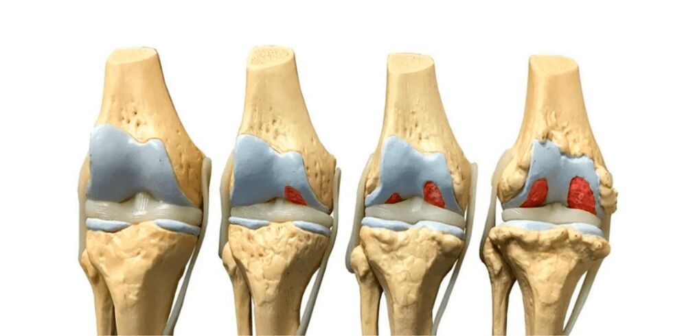 Degree of arthrosis of joints